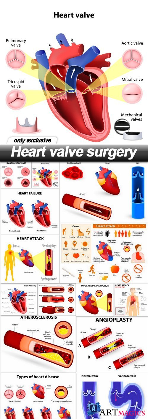 Heart valve surgery - 14 EPS
